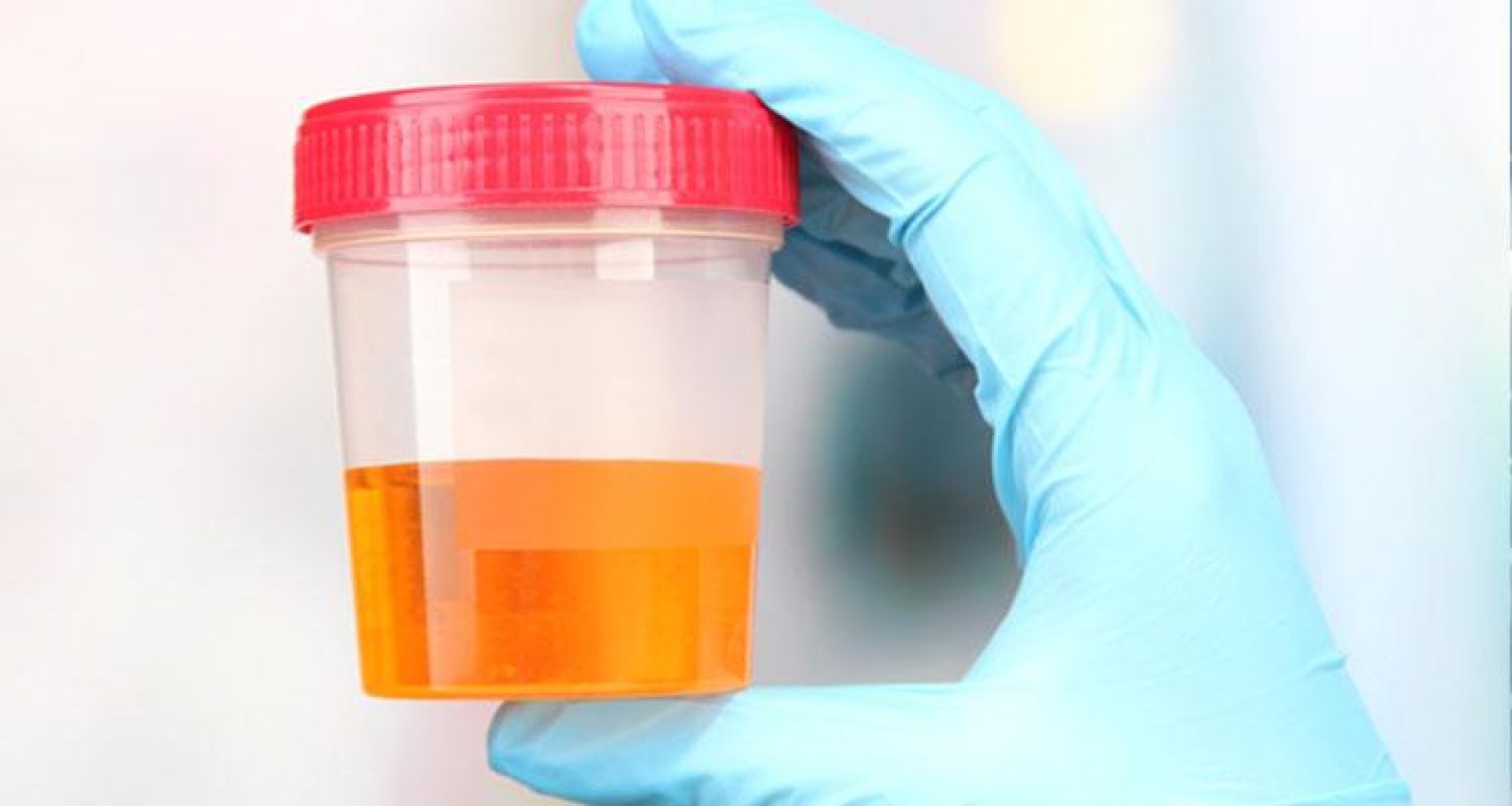 ESPERMATOZOIDES EN ORINA. Causas más comunes.